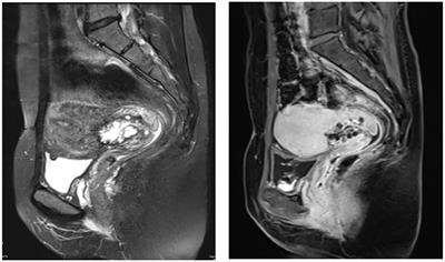 Atypical lobular endocervical glandular hyperplasia: two case report and literature review